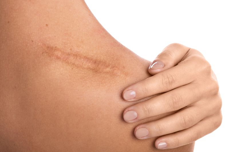 Scar on a shoulder Scar on a shoulder